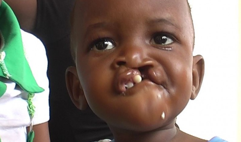 Bas-Congo : opérations chirurgicales gratuites  du bec de lièvre