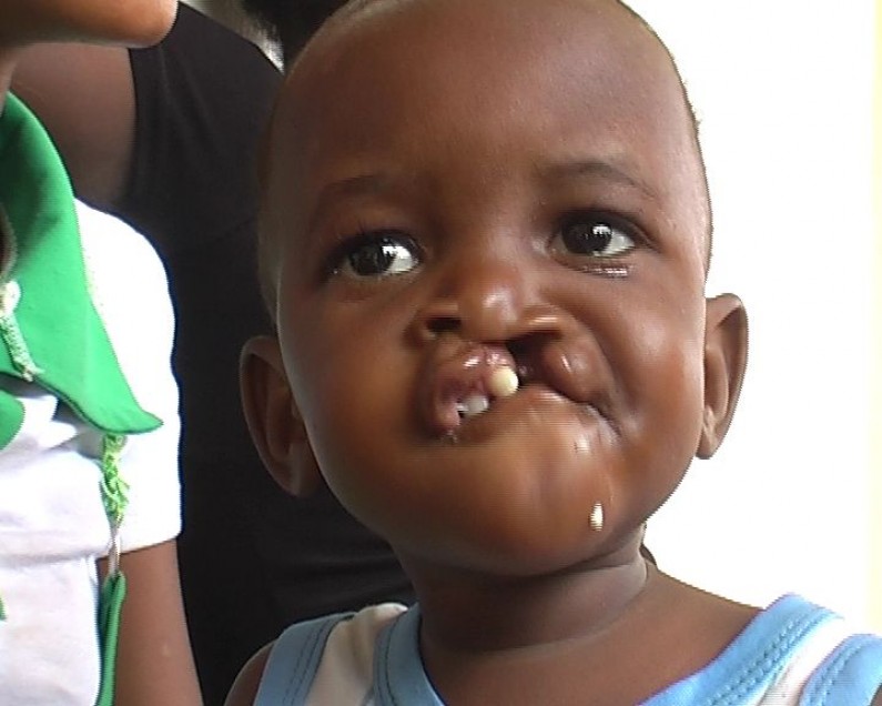 Bas-Congo : opérations chirurgicales gratuites  du bec de lièvre